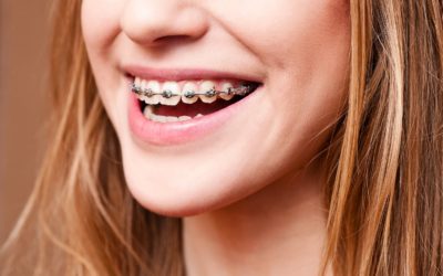 Les appareils dentaires fixes